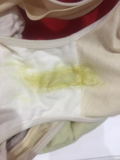 孕期白带多发黄瘙痒怎么办