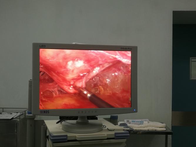 乳腺囊肿的腔镜微创手术