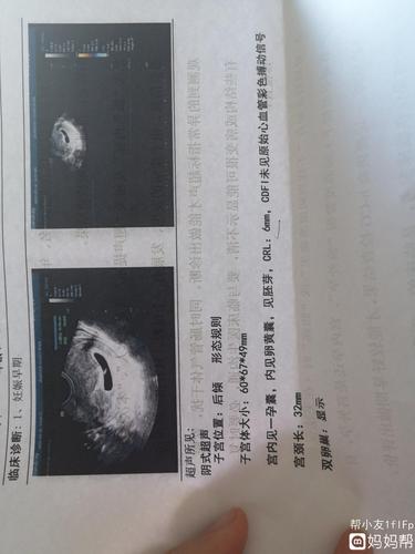 胎芽6mm,还没有胎心,医生说没有保胎的