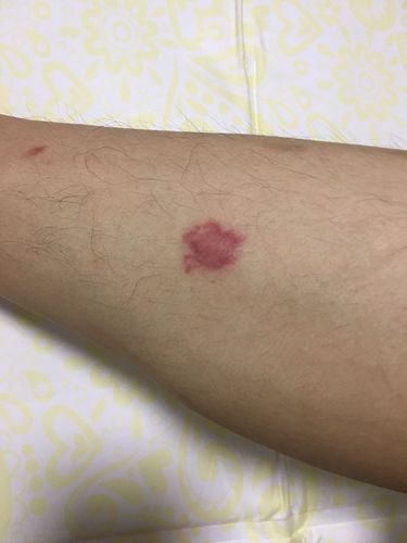 小腿上突然出现像是淤血的红斑是怎么回事?