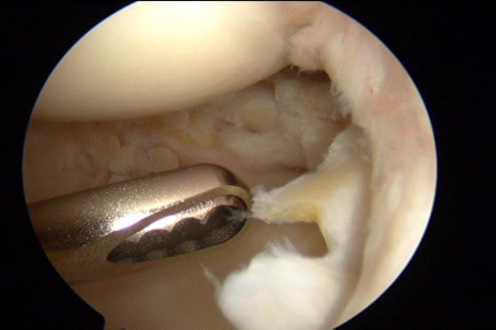 关节镜下治疗半月板撕裂2例