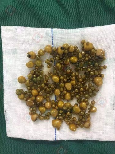 体出现这3个异常不用猜胆囊结石要来报到了