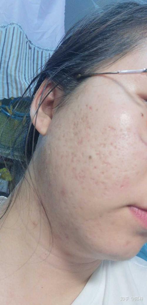 满脸痘坑的人都活得怎么样