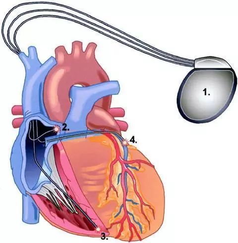 邹建刚教授参加第38届美国心律学会年会 邹建刚教授表示,三腔起搏器的