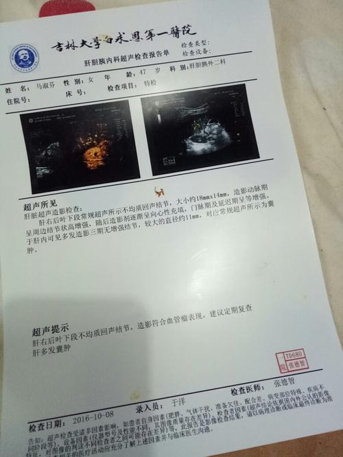 肝脏超声照影提示符合血管瘤的表现是啥意思