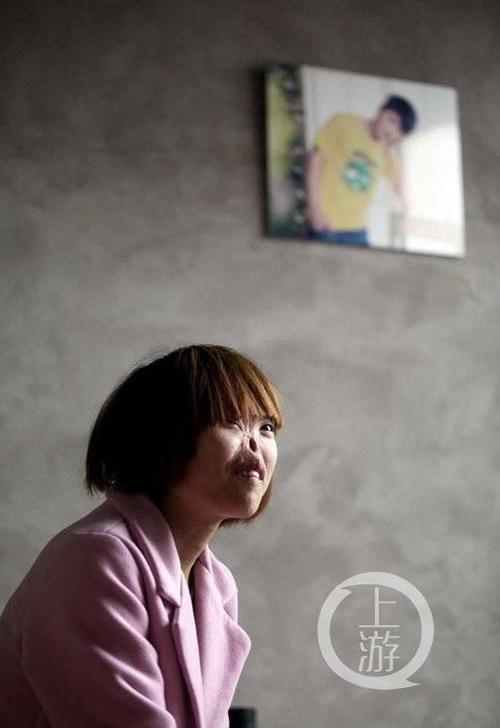 女子被老鼠吃掉鼻子相貌异于常人 老公:我喜欢(图)
