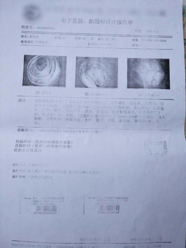 今年3月27日,黄利琼去医院体检,在医生的建议下作了胃镜检查,检查报告