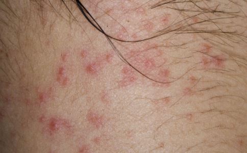 艾滋早期症状图片之:皮疹_艾滋病图谱__99健康网手机版