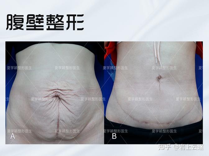 腹壁成形术有什么优势呢?