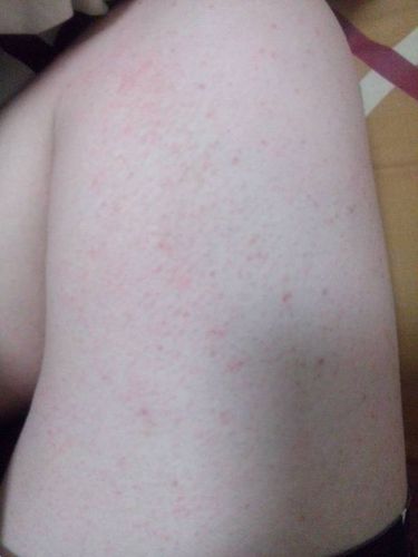 请问这是什么症状.不痛不痒,但是喝酒就感