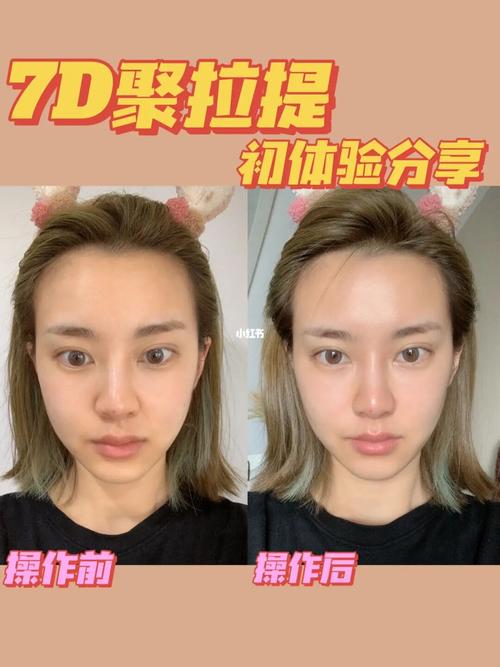 7d聚拉提|操作前后对比效果大吗?_法令纹_保养_苹果肌
