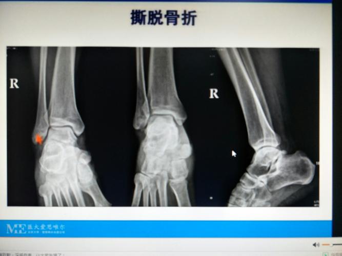 骨折的x线诊断
