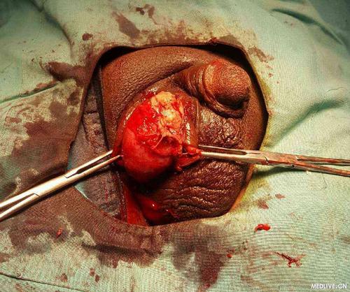 睾丸切除术全程视频