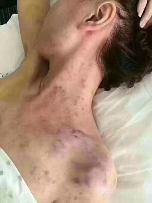每日小知识:淋巴癌是世界上唯一不能治愈的癌症