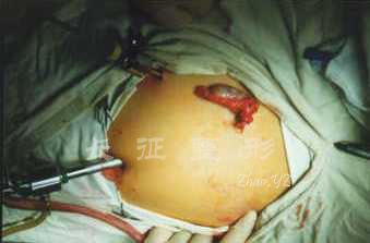 两性畸形专题讲座之六——男性假两性畸形(睾丸女性化