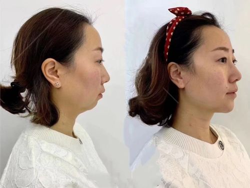 下巴后缩太严重,丑的不敢拍照片.