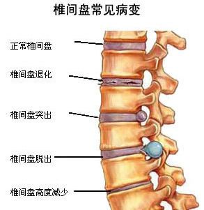 健康吧|年纪轻轻就有椎间盘疾病,这都怪你自己不动