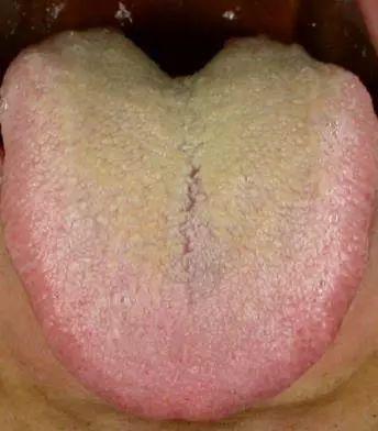 "中年油腻男",很可能是痰湿体质 | 中医语音