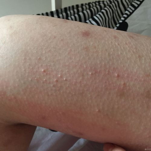 疥疮【疑难】患者