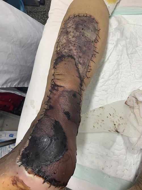 做植皮失败的云南患者