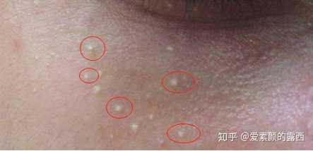 长脂肪粒了要怎么去除?