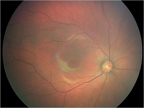 视网膜母细胞瘤急进型后极部早产儿视网膜病变眼底出血儿童保健科