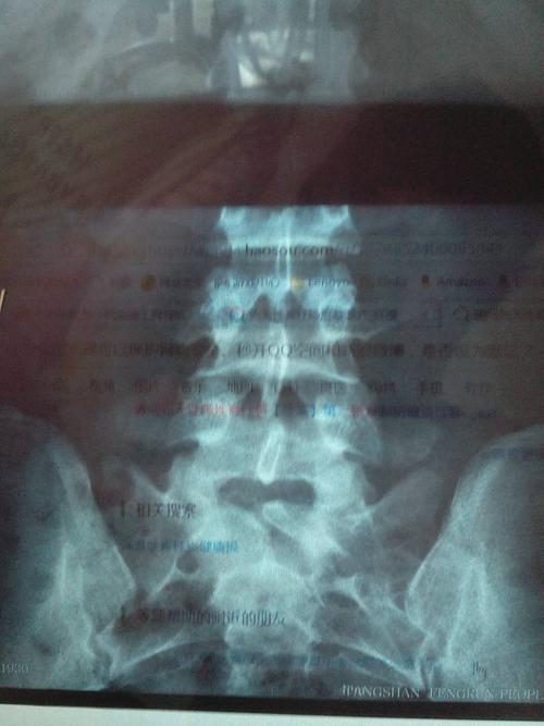 帮忙看一下这个先天性脊柱隐形裂是腰几有隐形裂?现在