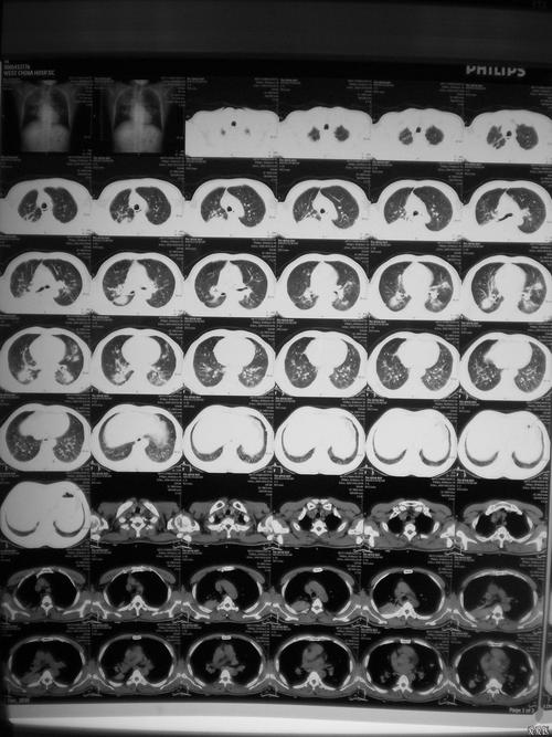 怀疑结核或者尘肺的!大家给点意见!