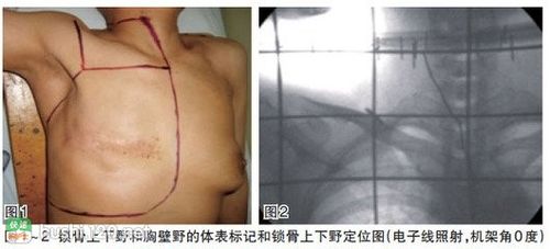 乳腺癌根治术的负压引流