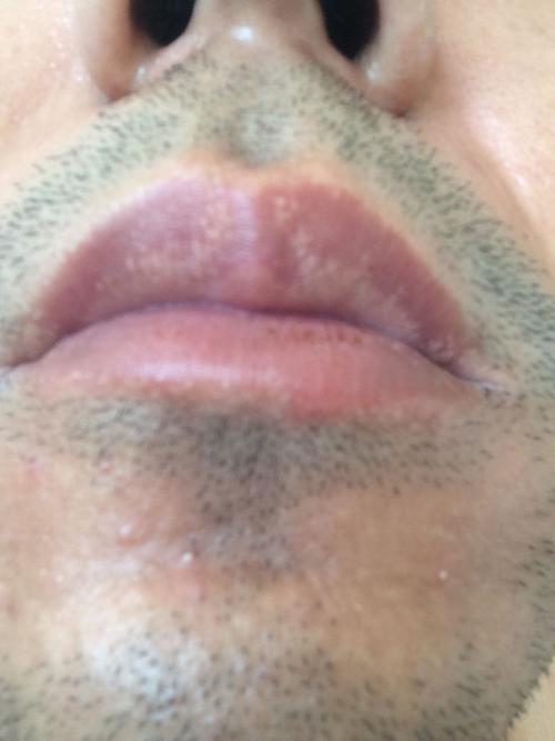 嘴唇上有白斑是怎么回事