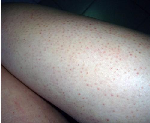 毛周角化会有哪些症状呢