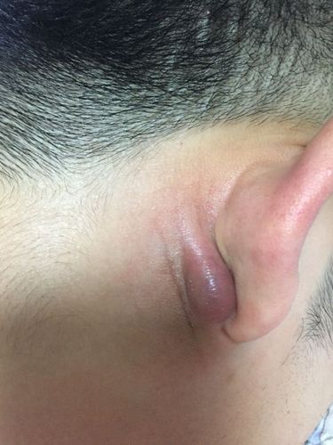 耳朵后面长了个包 起初是个小豆豆 有点疼 这过了大概