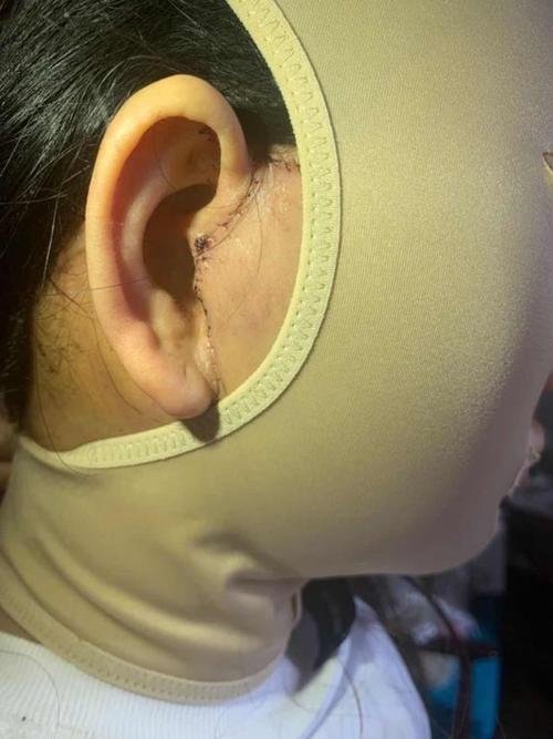 这几天伤口护理一点都没怠慢,所以恢复还挺快,再来看看我的整体皮肤