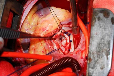 重大疾病的心脏瓣膜手术