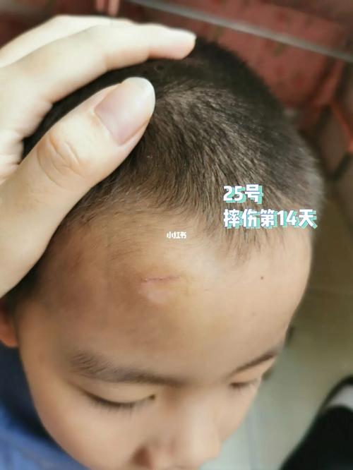 医用胶水粘住的伤口_万达广场自由行热门攻略_万达广场_医疗健康_医疗