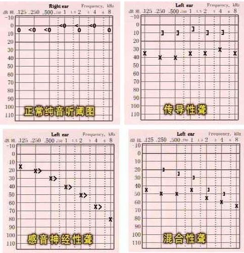 如何凭纯音听力测试图来断定耳聋程度