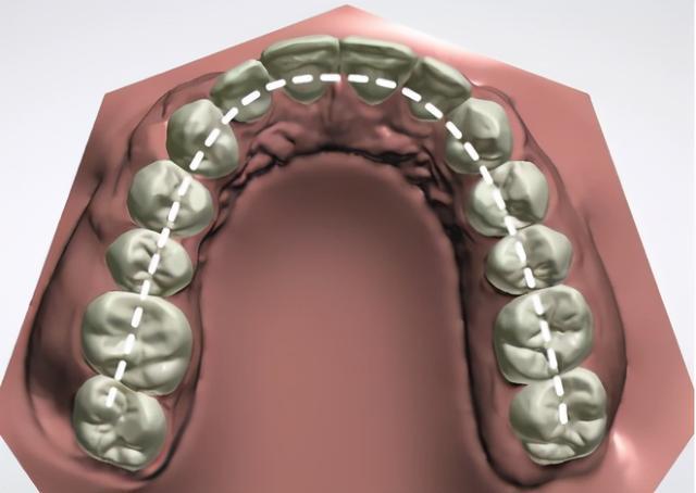 我们一般正常人的牙弓外形,呈现的是较为整齐规划的弧形,两侧对称