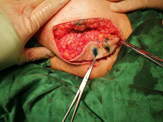 驻马店市中医院乳腺科开展乳腺癌保乳手术,为您的健康美丽保驾护航!