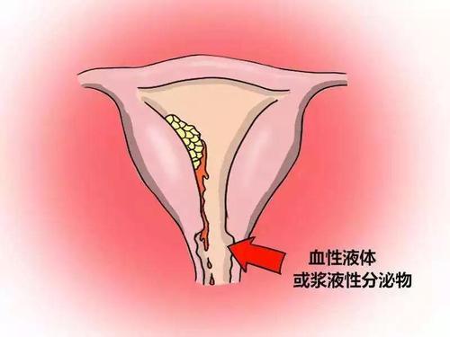 功能失调性子宫出血