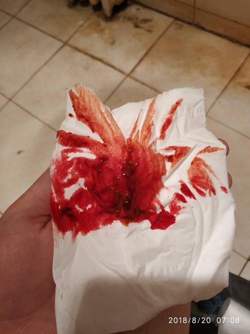 18岁大便出血一个月了,无痛感 出血量很大擦的时候都能透过手纸到手上