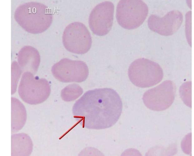 嗜多色性红细胞内一个豪焦小体,多见于溶贫,巨幼贫和mds.