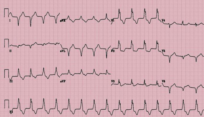 一例75岁心绞痛患者的心电图