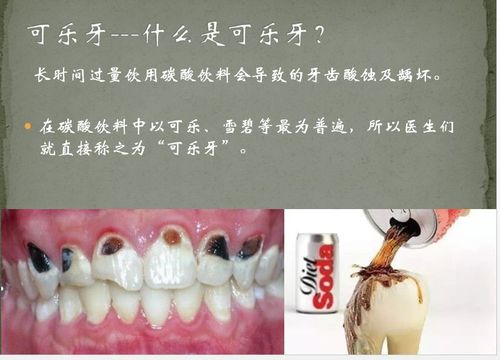 爸爸妈妈大讲堂:可乐与牙齿