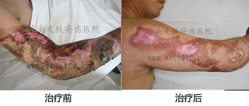 入院后完善检查,应用济南皮肤疮疡医院湿性干细胞激活疗法,给糖尿