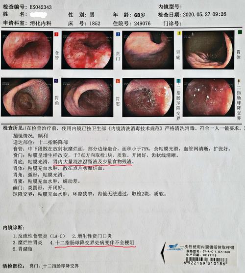 胃镜下可见十二指肠球-降部交界处梗阻,病理:慢性炎