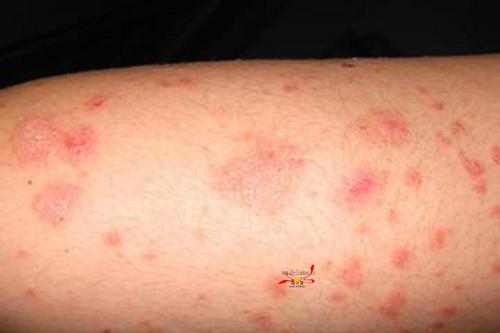 自身敏感性皮炎简介