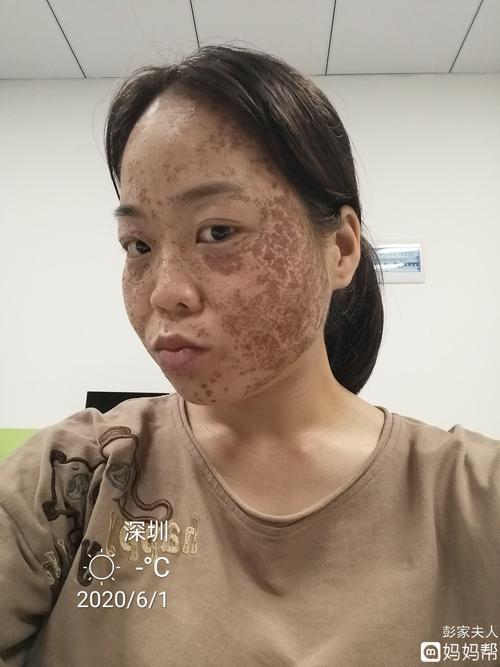 记录祛斑第三天,已经慢慢结痂没那么痛了