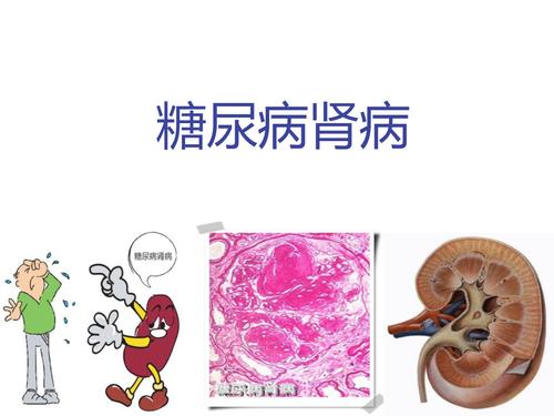 糖尿病肾病的发生和发展.ppt