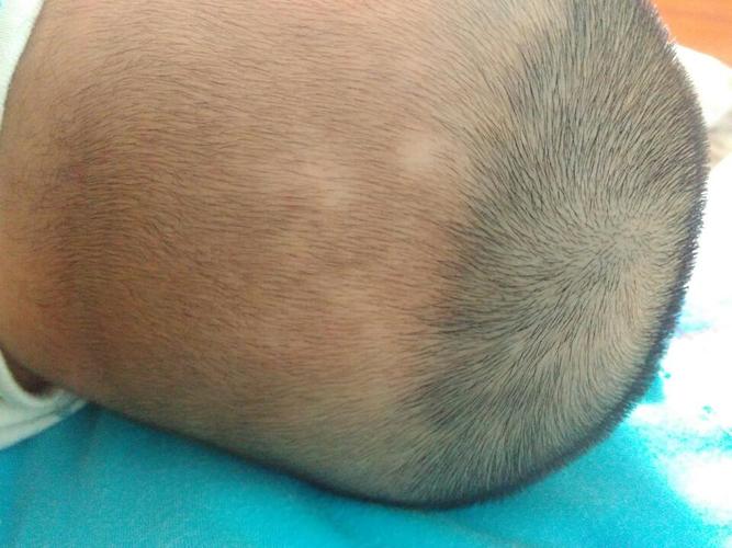 宝宝枕秃缺钙图