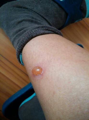 腿上长了个大水泡,橘黄色的,有点化脓,这是什么引起的?
